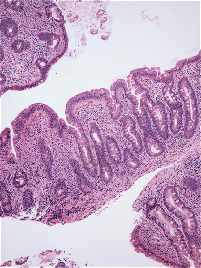 Stained photomicrographs of small intestinal biopsies from newly diagnosed celiac disease patients showing marked architectural distortion that comprise total villous atrophy, crypt hyperplasia and increased intraepithelial lymphocytes. [Dr. Govind Bhagat, Dept of Pathology and Cell Biology, Columbia University Medical Center]