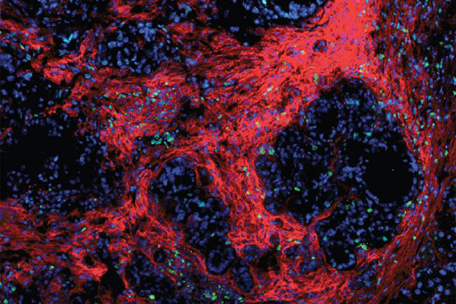 Pancreatic tumors are surrounded by a protective 