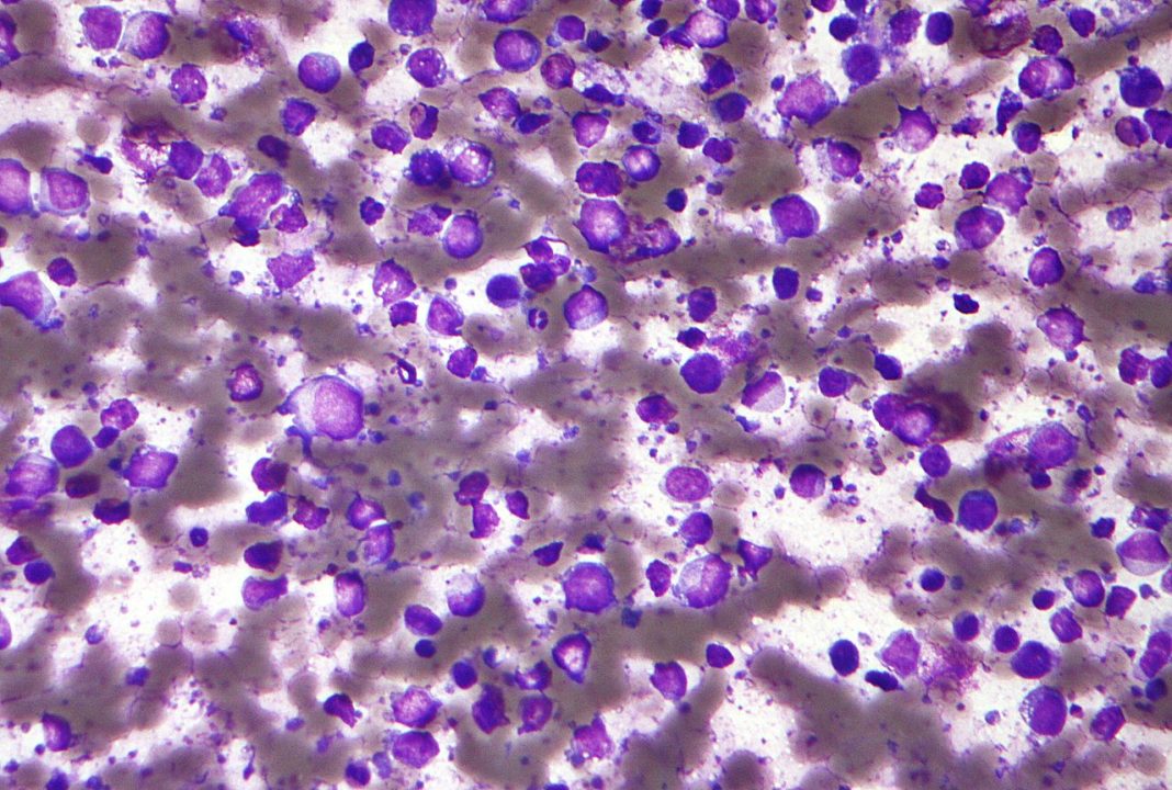 Epizyme is halting a Phase II trial assessing its lead candidate tazemetostat in relapsed and/or refractory diffuse large B-cell lymphoma (pictured)