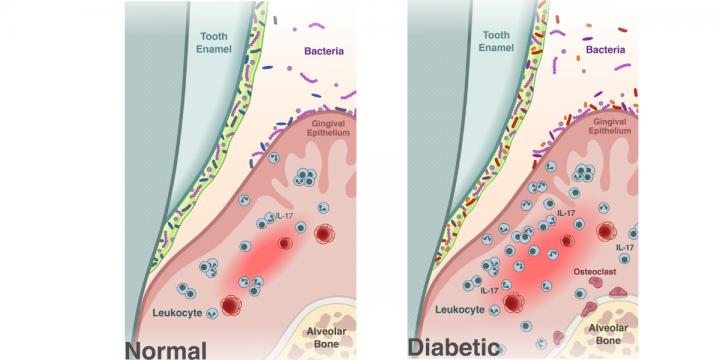 Researchers found that diabetes (panel on right) shifts the oral microbiome, transforming it into a more inflammatory environment and promoting bone loss, characteristics of the gum disease periodontitis. [University of Pennsylvania]