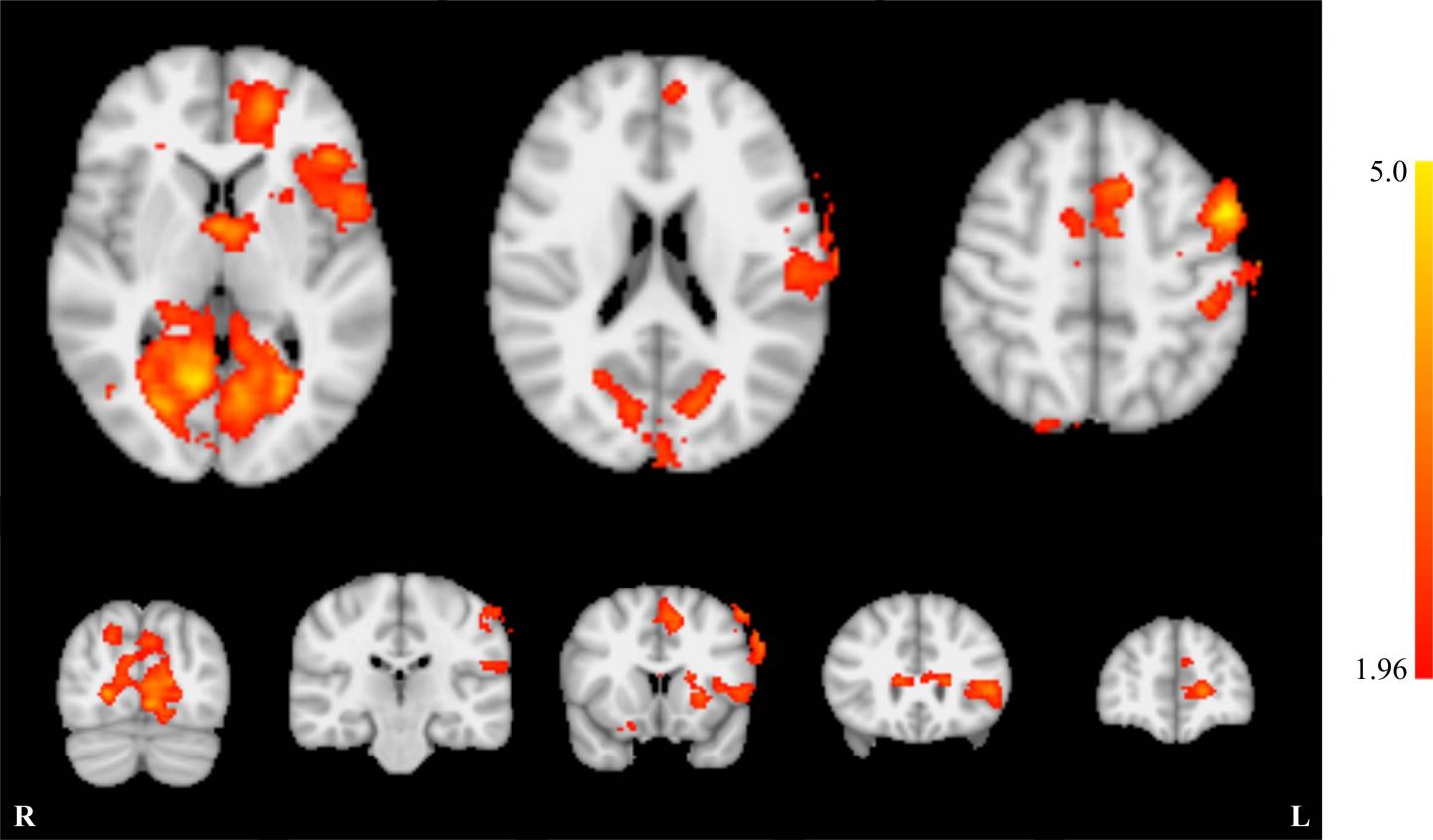Whole-brain effects of neurofeedback training. [Radiological Society of North America]