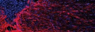 Reactive astrocytes surround the lesion site in the injured spinal cord.  [UT Southwestern]