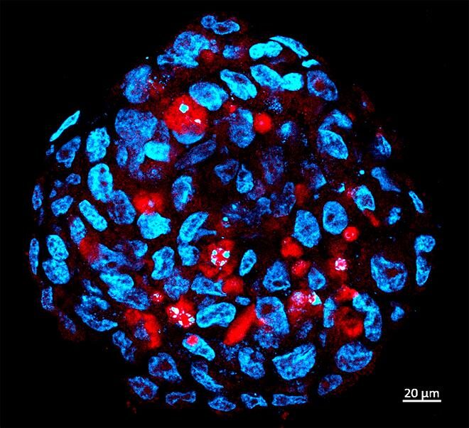 Tumor sphere comprised of human medulloblastoma stem cells infected by Zika (red). [HUG-CELL]