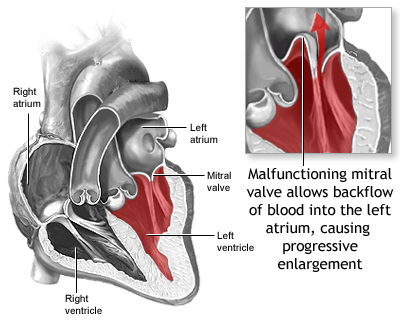 Gene Discovered as Cause of Mitral Valve Prolapse