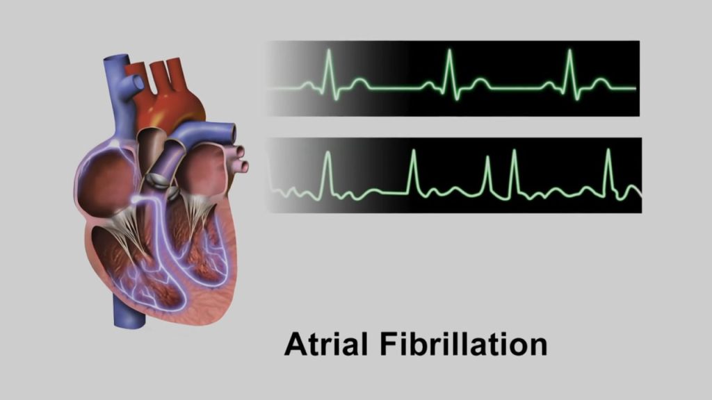 The top graph shows a normal cardiac rhythm