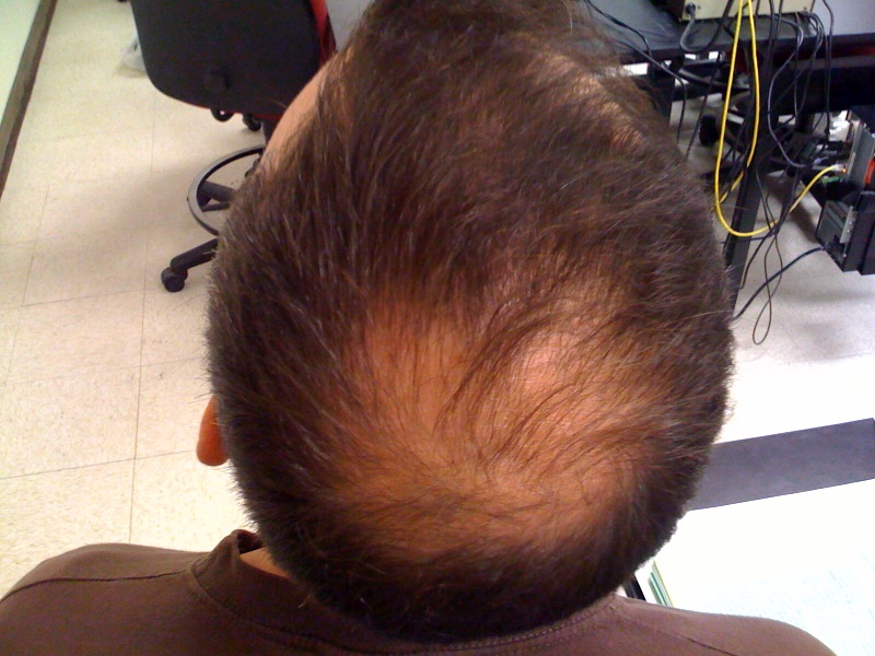 Researchers find over 200 genetic markers that help predict the odds of losing one's hair. [WikiCommons]