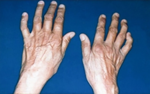 Individuals with a particular version of a gene have an increased risk for rheumatoid arthritis and the severity of bone damage. [National Library of Medicine]