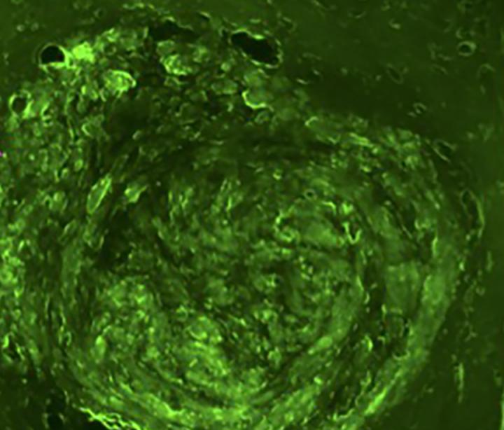 A team of engineers and physicians at Washington University in St. Louis have developed a technique that may allow physicians to retrieve biomarkers from a brain tumor through a simple blood test. This image shows a brain tumor in a mouse that has been treated with green fluorescent protein-transduced glioblastoma cells. [Washington University in St. Louis]