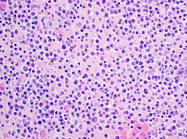 Multiple Myeloma Outcomes Linked to Fatty Acid Binding Protein