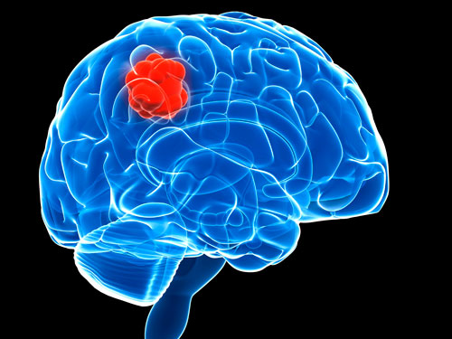 Neuroblastoma Deploys Energy-Draining Weapon against Immune System