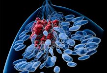 Epigenetic Process That Promotes Breast Cancer Metastases Uncovered