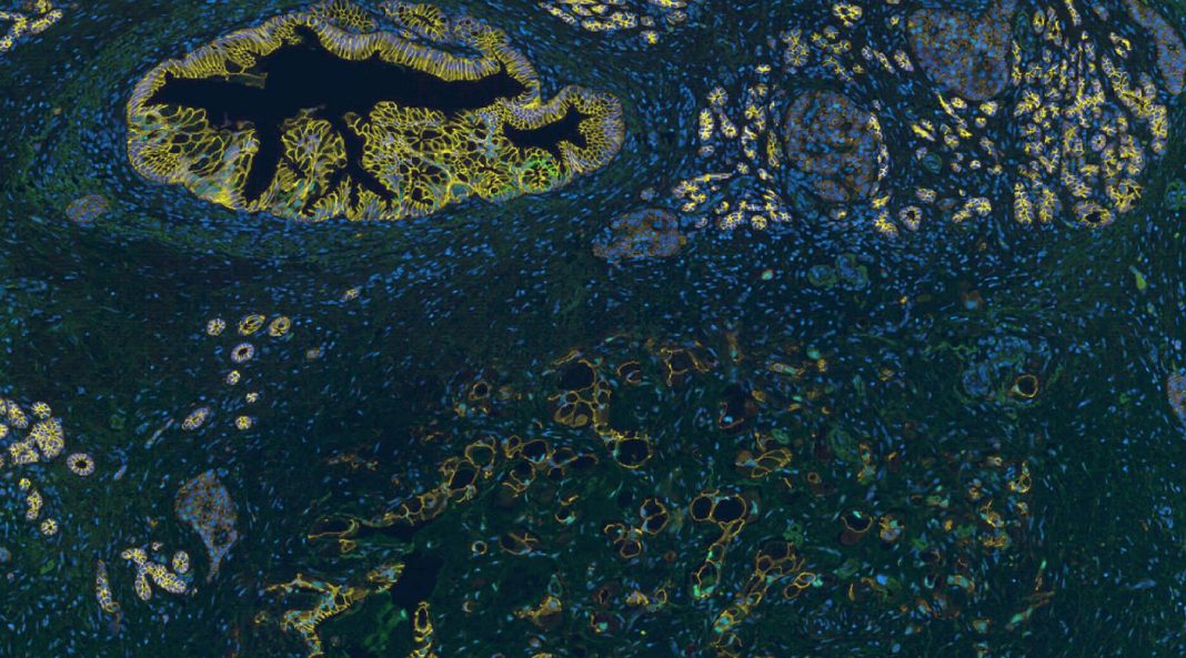 Aggressive pancreatic cancer cells undergo a mesenchymal-to-epithelial shift