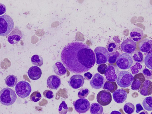 An oversized bone marrow cell, typical of chronic myeloid leukemia, is shown. [Difu Wu]