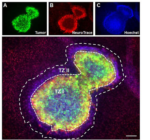 VOGIM: Tumor-induced cell death and tumor zones I and II. The tumor is shown in green, damaged neurons are shown in red and cell nuclei are shown in blue. There are at least two distinct tumor zones (TZ I and TZ II) visible. [FAU]