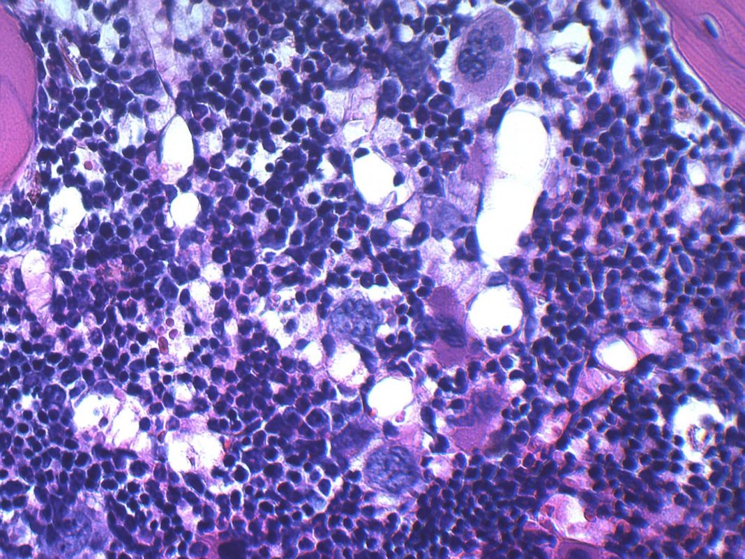 This micrograph shows bone marrow cellularity and composition in a genetically modified obese mouse (bottom). [Cincinnati Children's]