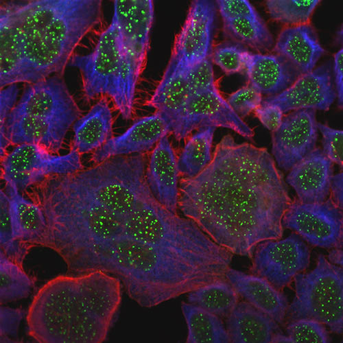 Blocking a signaling pathway could prolong residual catenation and kill cancer cells. This image shows aneuploidy in cancer cells. Green: chromosome marker. Red