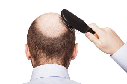 Potential Therapeutic Treatment for Androgenetic Alopecia