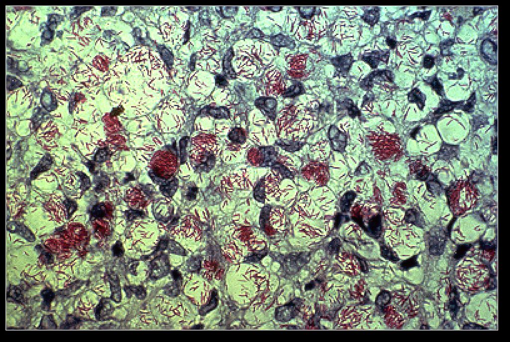 Leprosy is a chronic human disease caused by the yet-uncultured pathogen <i>M. leprae</i>. [US Department of Health and Human Services]