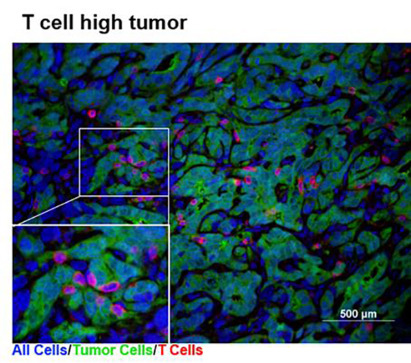 Pancreatic Tumors Run Hot, Cold Depending on Tumor-Cell-Intrinsic Factors