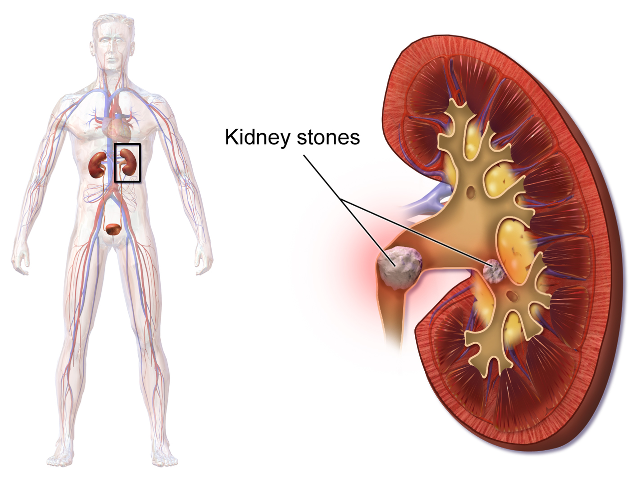 new research kidney stones
