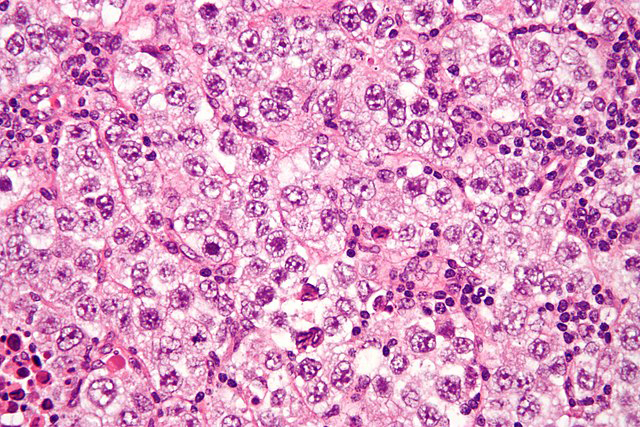 Seminoma, a common germ cell tumor. [<a href=