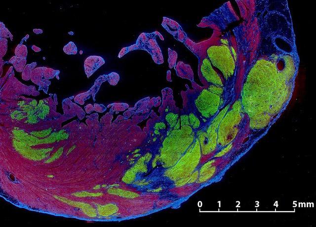 Stem cell-derived human cardiomyocytes (green) integrated into the scarred area (blue) of a heart wall (red). [Xiulan Yang/Murry Lab]