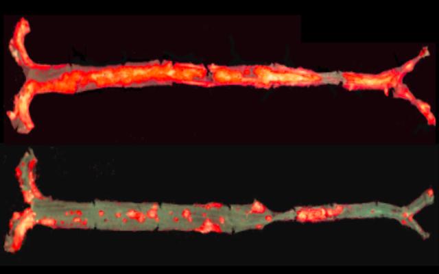 The aorta of a mouse model of atherosclerosis on a high-fat diet for 12 months (top) has significantly more plaques (bright red) than the aorta of the same type of mouse that also produces the anti-inflammatory E06 antibody (bottom). [UC San Diego Health]