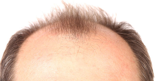 Skin Organoids May Treat Baldness
