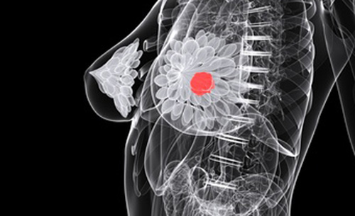 Artificial Intelligence System Improves Breast Cancer Detection