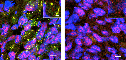 Fewer stress granules (yellow) occur in cancer cells lacking G3BP1 (right) than in controls (left). Nuclei are labeled blue. [Somasekharan et al.