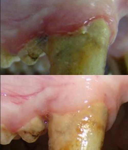 Researchers Reverse Signs of Chronic Periodontitis