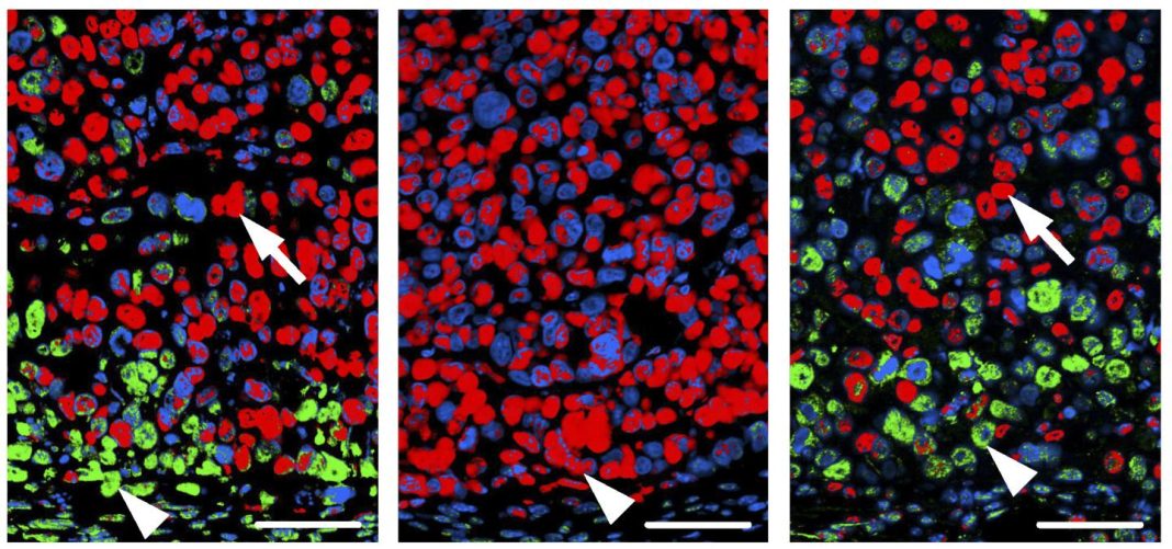 Human colon cancer cells injected into mice form tumors (left) consisting of both MAPK-active cells (green) and NOTCH-active cells (red). Treatment with the MAPK inhibitor selumetinib results in tumors consisting of NOTCH-active cells only (center)