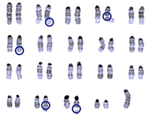Jumping genes did more jumping in the genomes of cells lacking histone H3.3. These cells also had more abnormalities in their chromosomes (circles). [Laura Banaszynski]