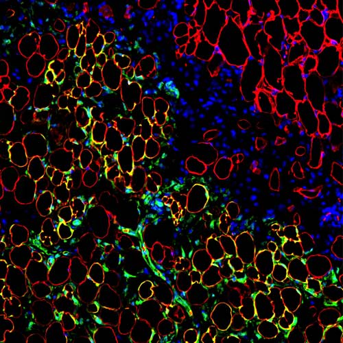 Fat cells (yellow) descended from transplanted human mesenchymal stem cells (green) inside a mouse 28 days after co-transplantation. Red: fat cells; blue: nuclei. [Juan Melero-Martin