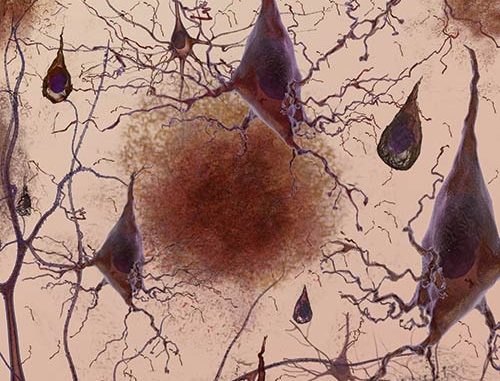 Alzheimer’s Disease Risk Linked to Rare Damaging Genetic Variations