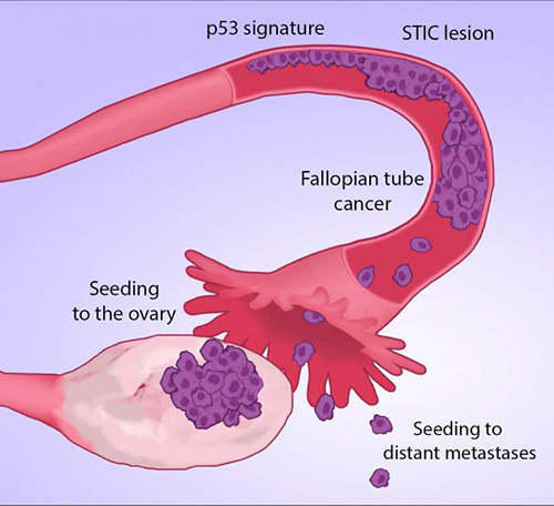 Discovery that Ovarian Cancer Originates in Fallopian Tubes May Aid Earlier Diagnosis