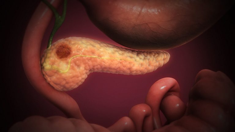 Inherited Pancreatic Cancer Gene Mutations Discovered in Patients with No Family History
