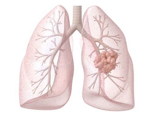Early Circulating Lung Cancer DNA Found by Hopkins Team