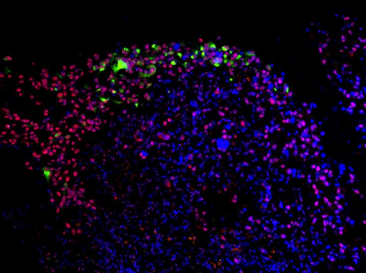 Zika virus (green) preferentially targets the stem cells (red) in a human glioblastoma. [Zhu et al.