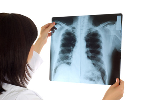 Veracyte is planning to launch Allegro's lead lung cancer test in the second half of 2015. [Elnur - Fotolia.com]