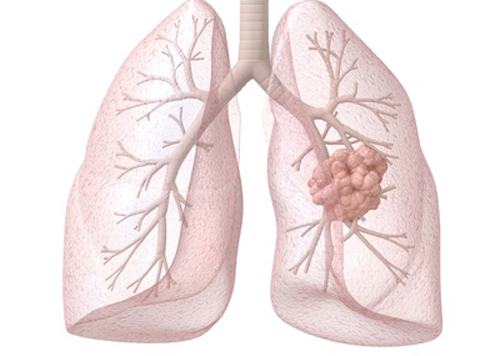 Test for NSCLC drug will be developed in collaboration with OSI on the Cobas 4800 PCR platform.[Sebastian Kaulitzk-Fotolia.com]