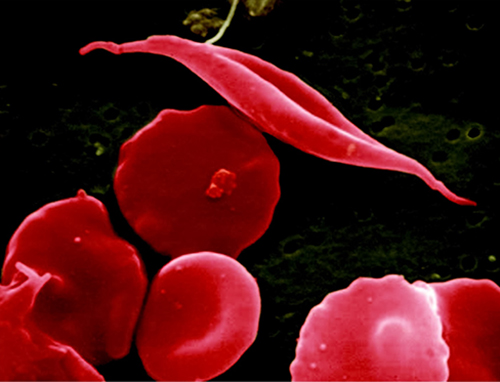 Researchers recently reports on a precision-engineered gene therapy virus, markedly reduced sickle-induced red-cell damage in mice with sickle cell disease. [NIH]