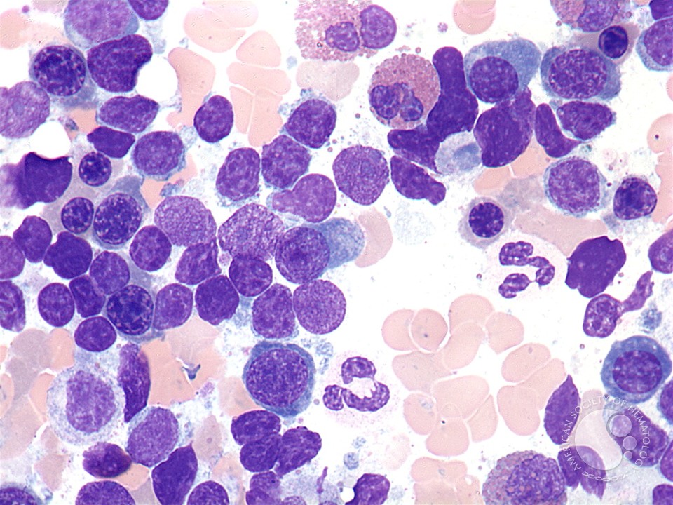 The combination of Imbruvica® (ibrutinib) and Rituxan® (rituximab) has been approved by the FDA as the first non-chemotherapy combination treatment for the rare blood cancer Waldenström's macroglobulinemia (pictured). [Source: American Society of Hematology].