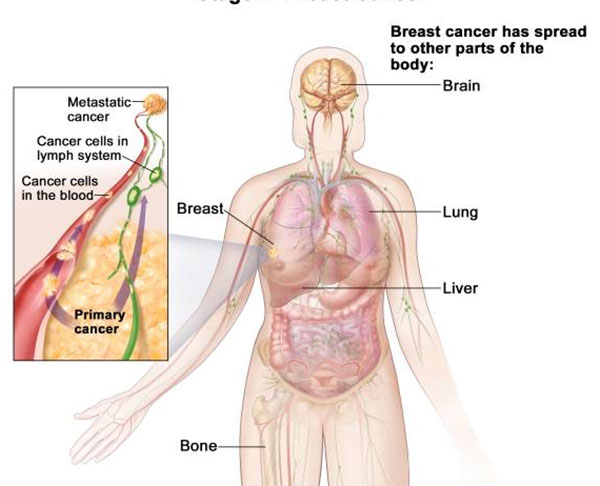 hpv behandlung zapfchen que es cancer benigno y maligno