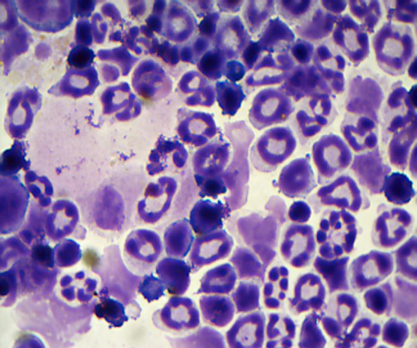 This microscopic image of myeloid cells taken from a genetic mouse model shows signs of the blood disease MDS (myelodysplastic syndromes), which can lead to leukemia. Instead of the normal appearance of myeloid blood cells--a smooth, round, donut-shape with a single nucleus--cells with MDS are underdeveloped, have multiple nuclei or are hyper-segmented. Researchers report in the journal Cancer Discovery identifying a gene called HIF1A that drives molecular processes leading to the diverse types of MDS disorders that affect people, opening the future possibility of developing new therapeutics for MDS. [source: Cincinnati Children's]