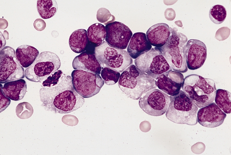 acute myeloblastic leukemia (AML)