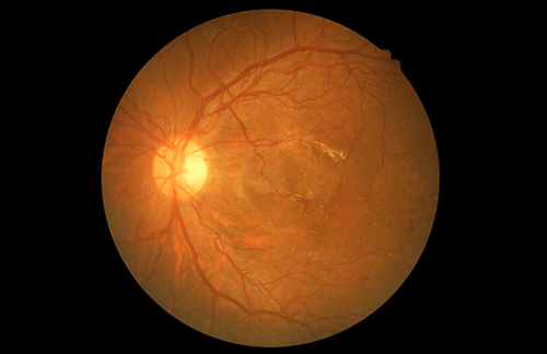 New Potential Therapeutic Candidate Found for Early Type 2 Diabetic Retinopathy