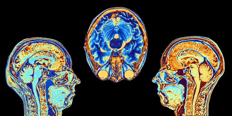Alzheimer’s Prediction by MRI Better Than Common Tests