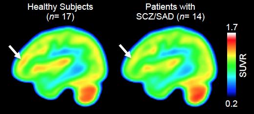 Schizophrenia Linked with Epigenetic Enzyme Dysregulation in Living Brains