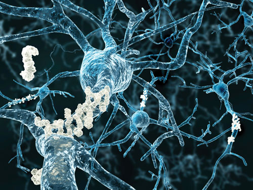 T Cells Could Represent Therapeutic Target for Alzheimer’s Disease